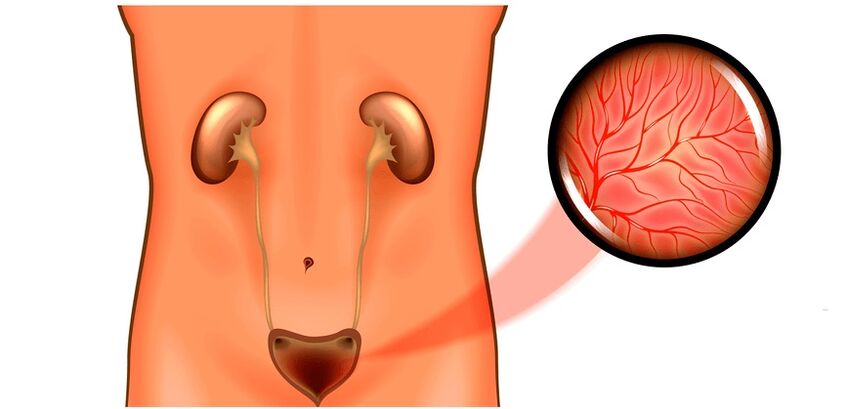 Cystitis in men and treatment