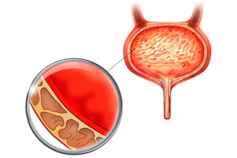 Inflammation of the mucous membrane of the bladder with cystitis